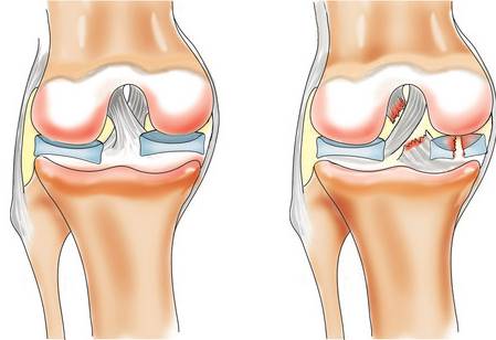 Анатомия коленного сустава9