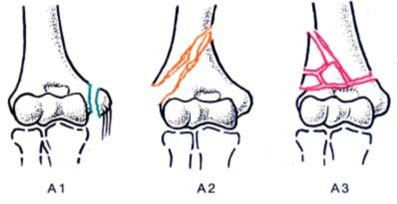 Перелом костей коленного сустава9