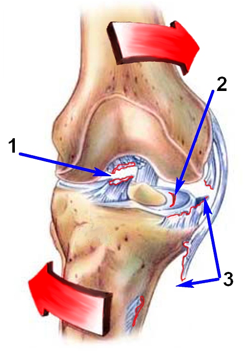 Повреждения связок коленного сустава9