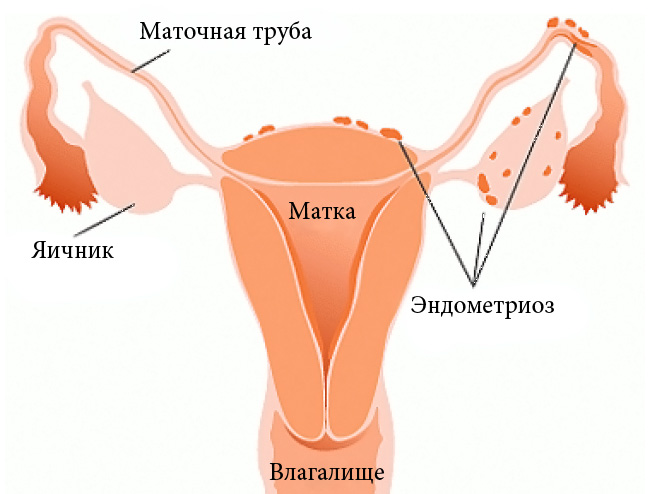 Беременность после лапароскопии 10