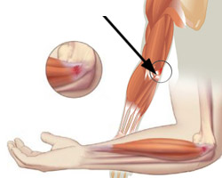 Боль в локте: причины и лечение, боли от плеча до локтя10