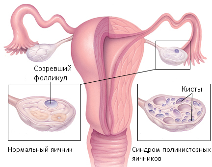 Первичный и вторичный гипогонадизм у женщин: сипмтомы, причины, фото10