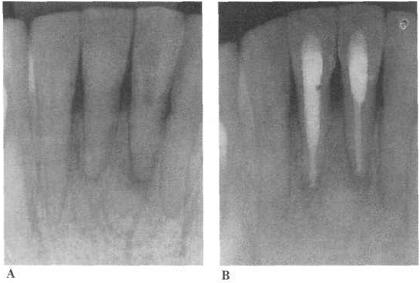 Перелом корня зуба: лечение, методики терапии10
