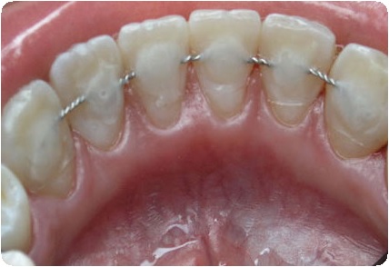 Вывих зуба: полный и неполный. Вывихи молочных зубов у детей10