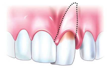 Травматическое повреждение зубов: первая помощь, лечение, последствия9