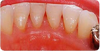 Препарирование зуба: показания, этапы, методы, последствия10