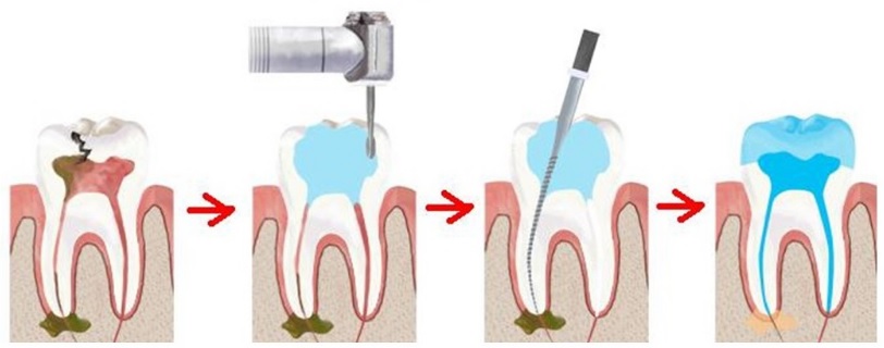 Методика препарирования зубов: показания, этапы10