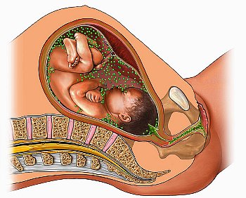 Узкий таз при беременности: степени, течение родов10