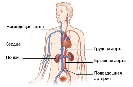 Коарктация аорты: симптомы, диагностика, лечение10