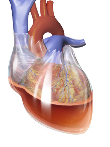 Злокачественная опухоль сердца10