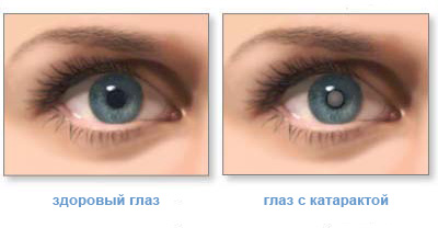 Ухудшение зрения: симптомы, причины, лечение, что делать. Категория болезни глаз. 10