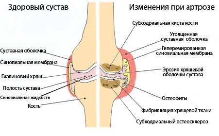 Артроз коленного сустава: лечение, симптомы, видео и фото, степени10