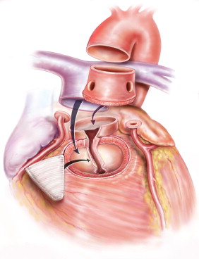 Стеноз аортального клапана: лечение, операция10