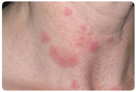 Туберкулез кожи: симптомы, признаки, лечение, фото11