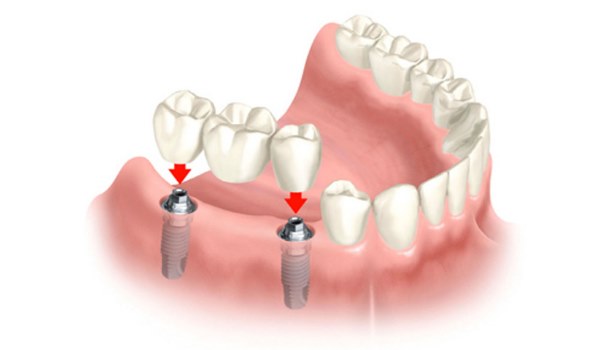 Реставрация депульпированных зубов. Основные компоненты11