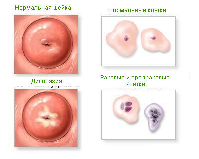 Дисплазия шейки матки: причины, степени, лечение11