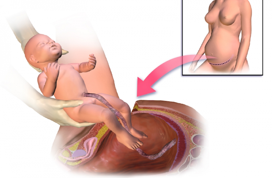 Узкий таз при беременности: степени, течение родов11