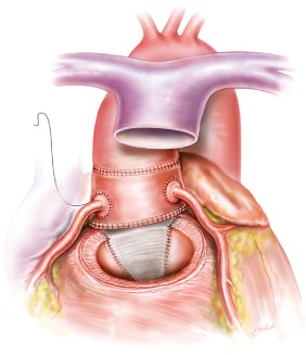 Стеноз аортального клапана: лечение, операция11