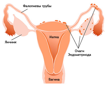 Гиперплазия эндометрия: симптомы, лечение, отзывы, фото12