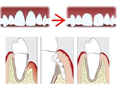 Перелом корня зуба: лечение, методики терапии12