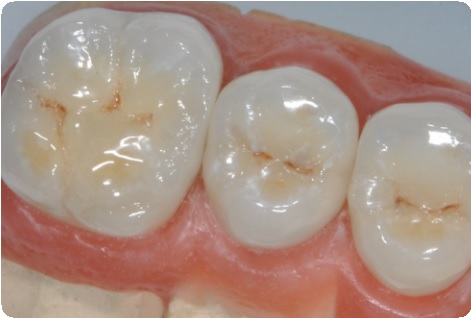 Методика препарирования зубов: показания, этапы12