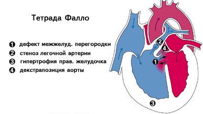 Порок клапана легочной артерии. Врожденный порок КЛА12