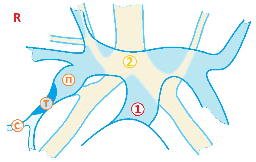 Осложнения при тетраде Фалло. Атрезия легочной артерии12