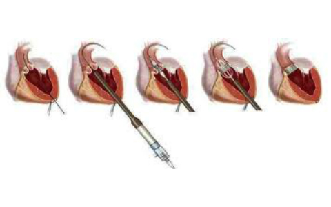 Стеноз аортального клапана: лечение, операция12