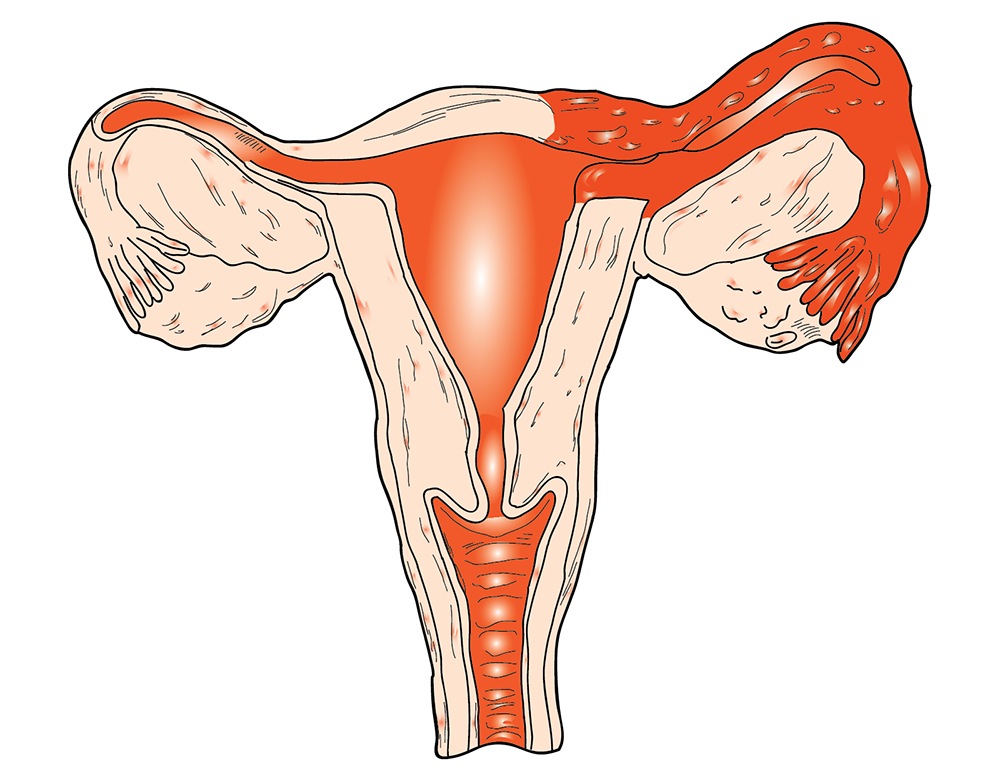 Хламидиоз у женщин: симптомы, лечение12