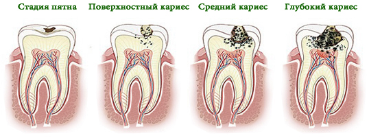 Препарирование зуба: показания, этапы, методы, последствия13