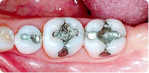 Методика препарирования зубов: показания, этапы13