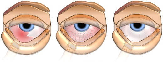 Ухудшение зрения: симптомы, причины, лечение, что делать. Категория болезни глаз. 13