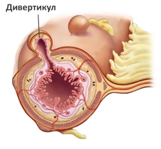 Дивертикулез мочевого пузыря: симптомы, диагностика, лечение13