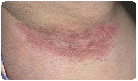 Туберкулез кожи: симптомы, признаки, лечение, фото13