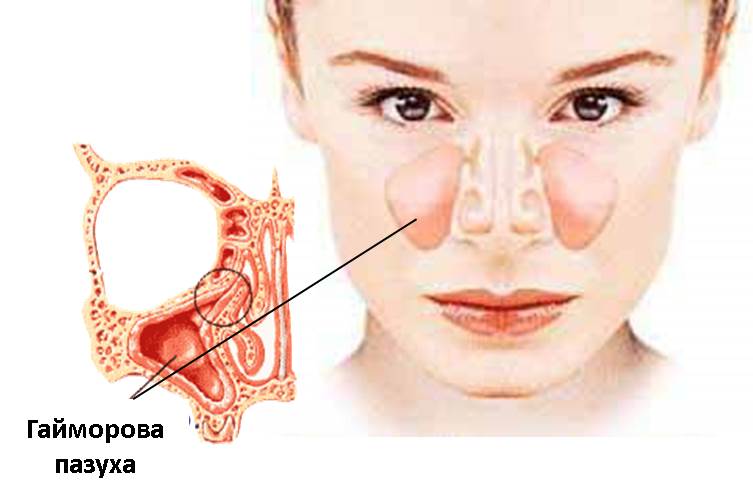 Полипы в носу: удаление, лазерное, эндоскопическое, лечение полипоза14