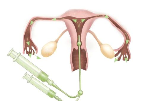 Бесплодие у женщин: причины и лечение бесплодия14