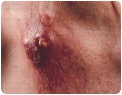 Туберкулез кожи: симптомы, признаки, лечение, фото14
