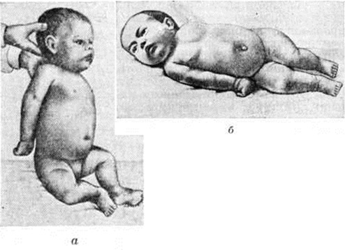 Врожденный сифилис: признаки, проявления. Сифилис плода14