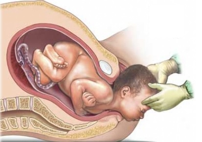 Беременность двойней: диагностика, ведение беременности14