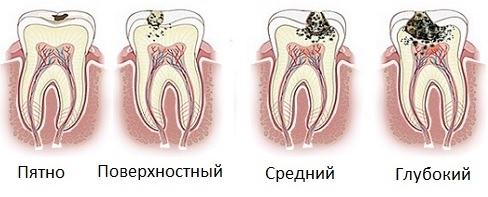 Ретенция зуба и другие дополнительные меры при реставрации14