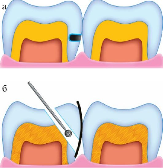 Методика препарирования зубов: показания, этапы15