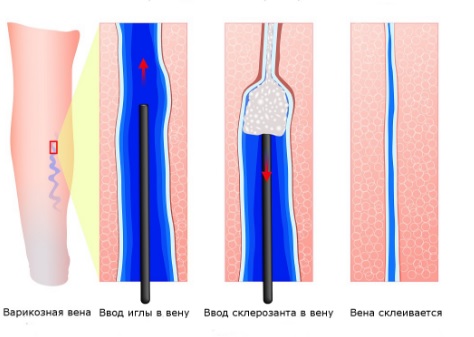 Склеротерапия вен нижних конечностей. Склеротерапия в косметологии. Цена, отзывы, фото15