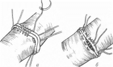 Анастомоз легочной артерии15