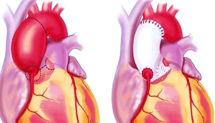 Стеноз аортального клапана: лечение, операция15