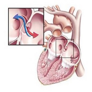 Коарктация аорты: симптомы, диагностика, лечение15