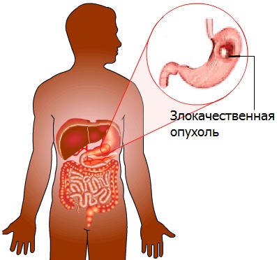 Рак желудка: симптомы, лечение, 1,2,3,4 стадии16