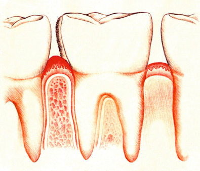 Операции в стоматологии: местная анестезия, гемостаз16