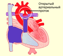 Коарктация аорты: симптомы, диагностика, лечение16