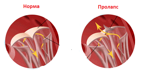 Стеноз аортального клапана: лечение, операция17