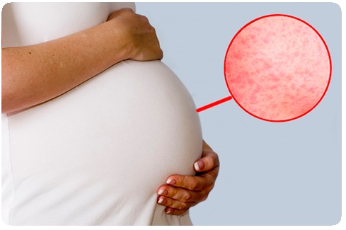 Инфекции при беременности. Оценка эффективности лечения17
